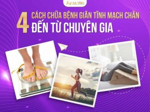 cách chữa bệnh giãn tĩnh mạch chân