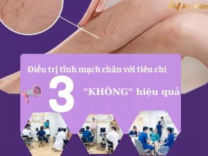 điều trị tĩnh mạch chân