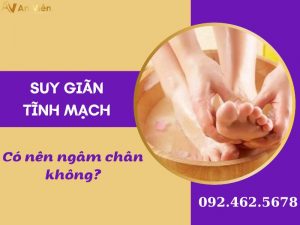 ngâm chân trị suy giãn tĩnh mạch
