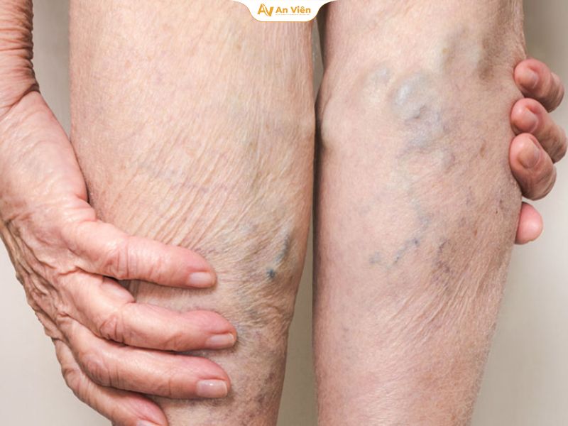 Tĩnh mạch chân nổi rõ