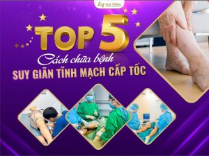 cách chữa bệnh giãn tĩnh mạch