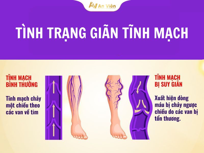 8+ Nguyên nhân giãn tĩnh mạch bạn cần biết! 10 Nguyên nhân gây ra giãn tĩnh mạch