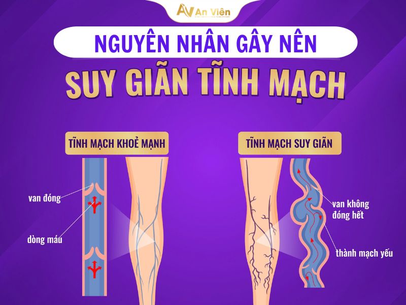 8+ Nguyên nhân giãn tĩnh mạch bạn cần biết! 11 Nguyên nhân gây ra giãn tĩnh mạch