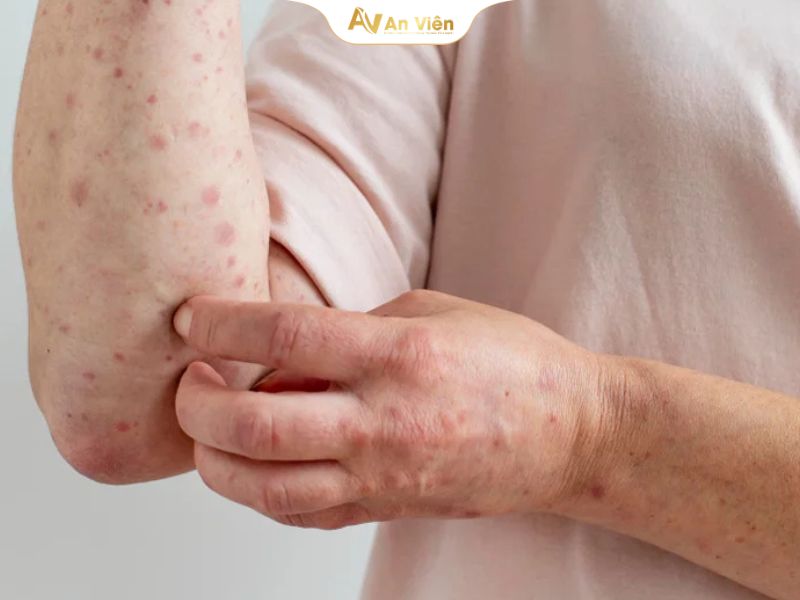 Chân bị vỡ mạch máu dưới da đến từ 5 nguyên nhân sau 13 Vỡ mạch máu dưới da