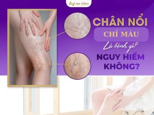 nổi chỉ máu ở chân