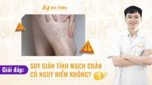 suy giãn tĩnh mạch chân có nguy hiểm không