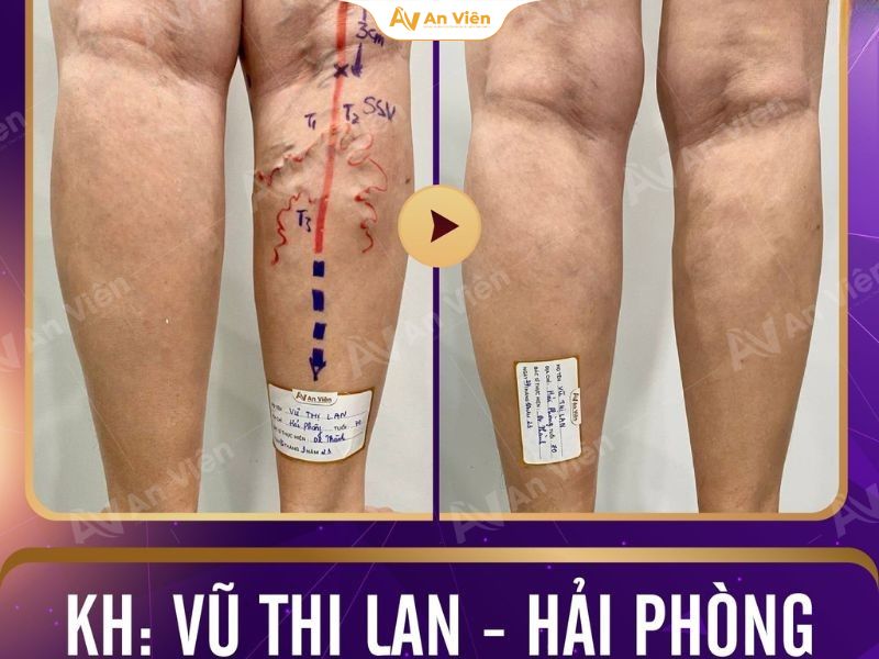 Suy van tĩnh mạch là gì? Hiểu đúng để phòng và điều trị kịp thời 19 Hình ảnh bệnh nhân bị suy van tĩnh mạch nặng và sau khi điều trị
