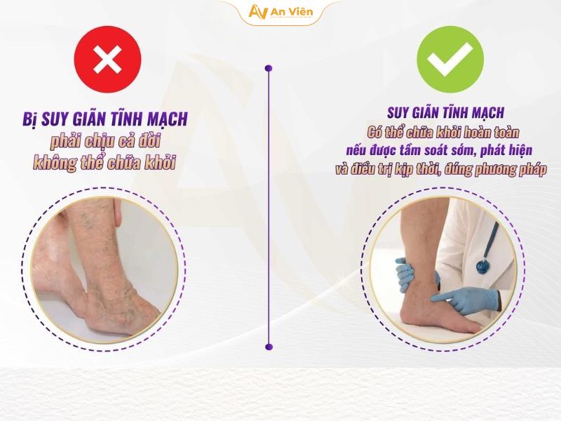 Suy van tĩnh mạch là gì? Hiểu đúng để phòng và điều trị kịp thời 17 Suy van tĩnh mạch trị được dứt điểm không?