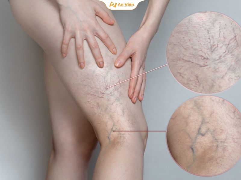 18 lời khuyên dành cho bệnh nhân suy tĩnh mạch từ chuyên gia 10 Suy tĩnh mạch là một bệnh lý mạn tính