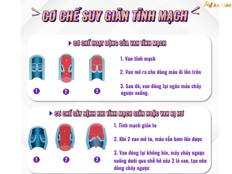 Bệnh giãn tĩnh mạch là như thế nào? Cần hiểu và xử lý đúng 10 bệnh giãn tĩnh mạch là như thế nào
