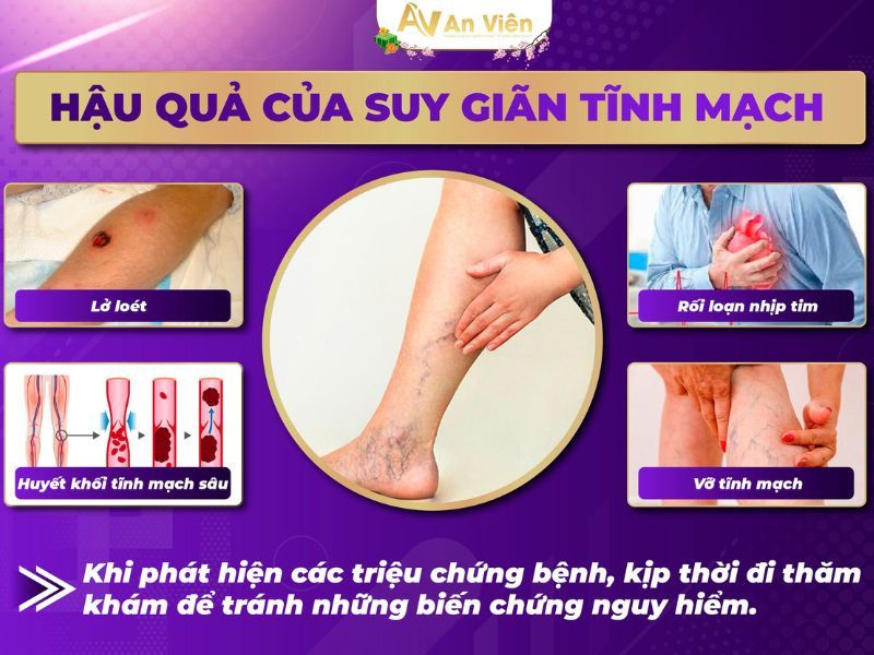 bị giãn tĩnh mạch ở chân phải làm sao