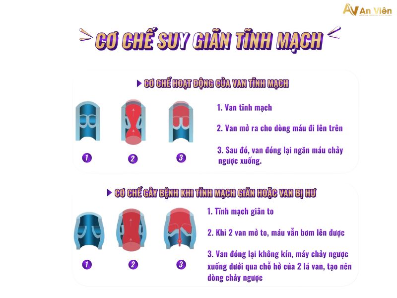 bị giãn tĩnh mạch ở chân phải làm sao
