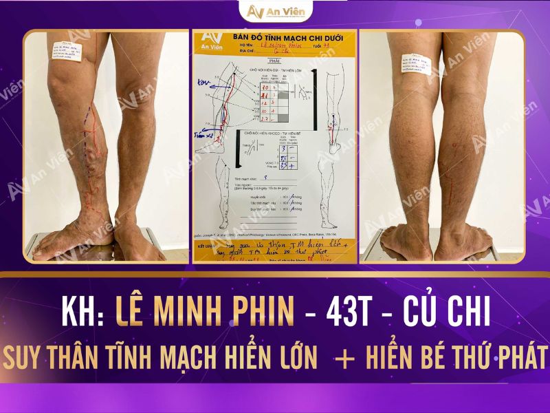 bị giãn tĩnh mạch ở chân phải làm sao
