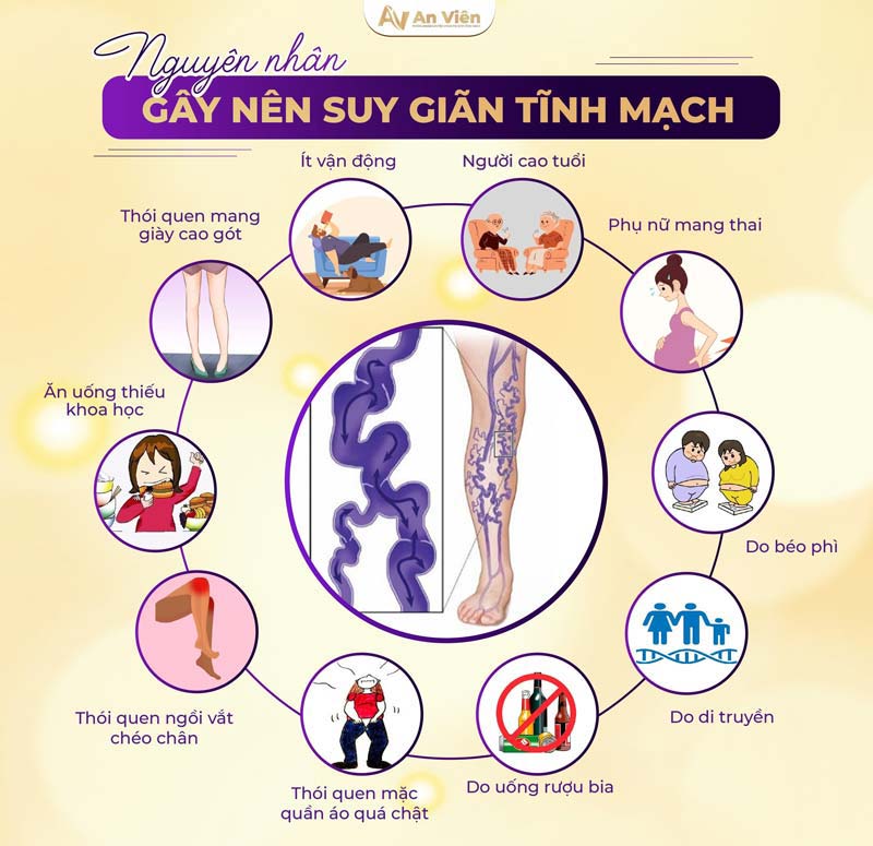 bị giãn tĩnh mạch ở chân phải làm sao