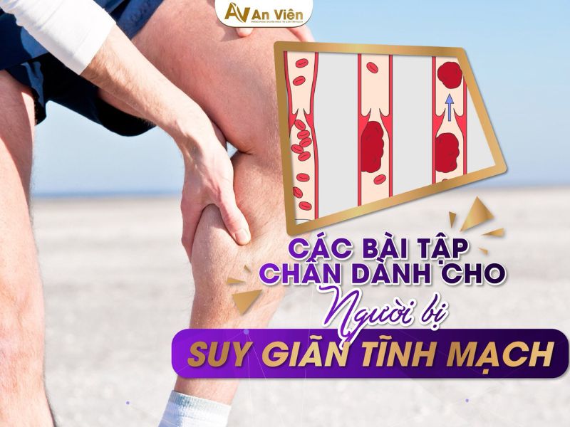 Nắm rõ cách chữa tĩnh mạch chân với 5 “KHÔNG” 12 cách chữa tĩnh mạch chân