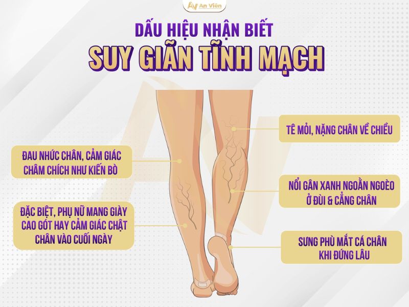 Chân nổi gân xanh là bệnh gì? 3 lý do chốt do giãn tĩnh mạch 12 Chân nổi gân xanh là bệnh gì?