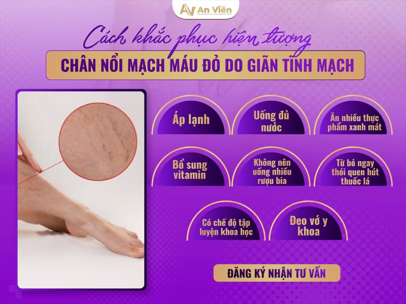 Chân nổi gân xanh là bệnh gì? 3 lý do chốt do giãn tĩnh mạch 16 chân nổi gân xanh là bệnh gì
