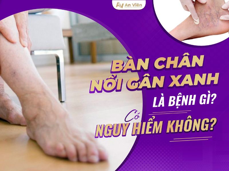 Chân nổi gân xanh là bệnh gì? 3 lý do chốt do giãn tĩnh mạch 10 chân nổi gân xanh là bệnh gì