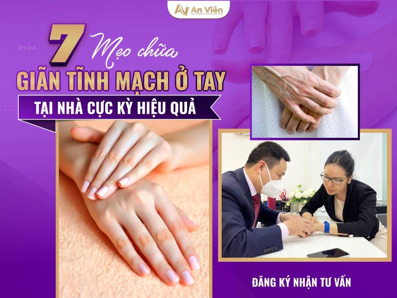 7 Mẹo chữa giãn tĩnh mạch ở tay làm tại nhà cực kỳ hiệu quả 15 giãn tĩnh mạch ở tay