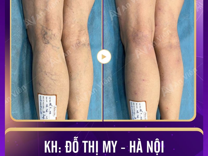 Báo giá mổ giãn tĩnh mạch chân hết bao nhiêu tiền ở An Viên 9 mổ giãn tĩnh mạch chân hết bao nhiêu tiền