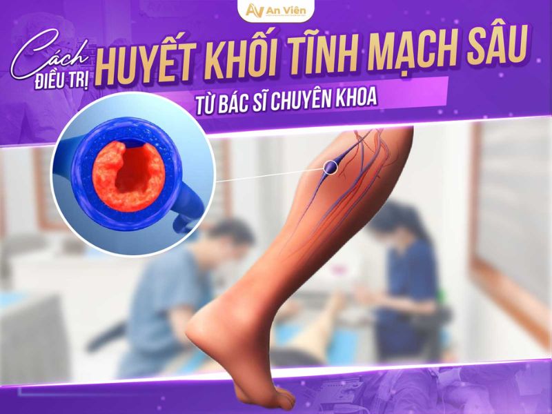 Bác sĩ hướng dẫn trị suy giãn tĩnh mạch mạn tính chi dưới với 5 phương pháp 18 suy tĩnh mạch mạn tính chi dưới