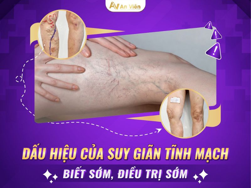 Bác sĩ hướng dẫn trị suy giãn tĩnh mạch mạn tính chi dưới với 5 phương pháp 12 suy tĩnh mạch mạn tính chi dưới