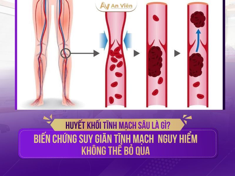 Bác sĩ hướng dẫn trị suy giãn tĩnh mạch mạn tính chi dưới với 5 phương pháp 13 suy tĩnh mạch mạn tính chi dưới