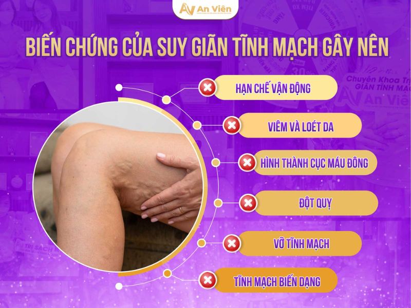 bị tắc tĩnh mạch chân phải làm sao