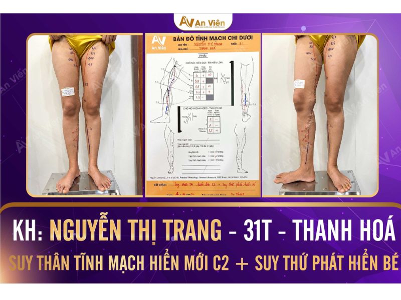 bị tắc tĩnh mạch chân phải làm sao
