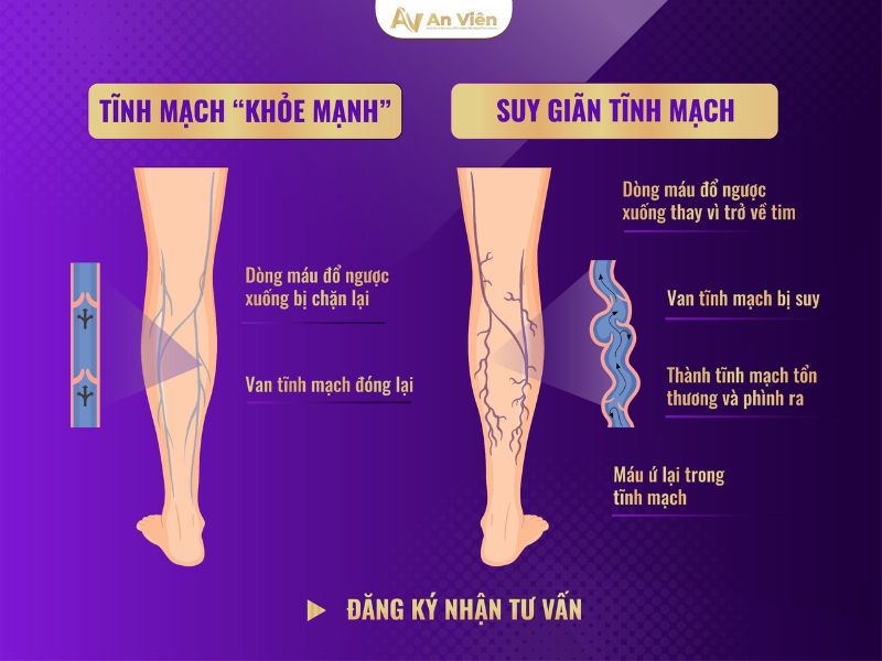 bị tắc tĩnh mạch chân phải làm sao