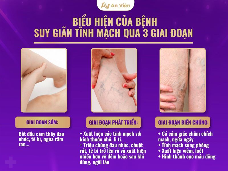chữa suy giãn tĩnh mạch chân