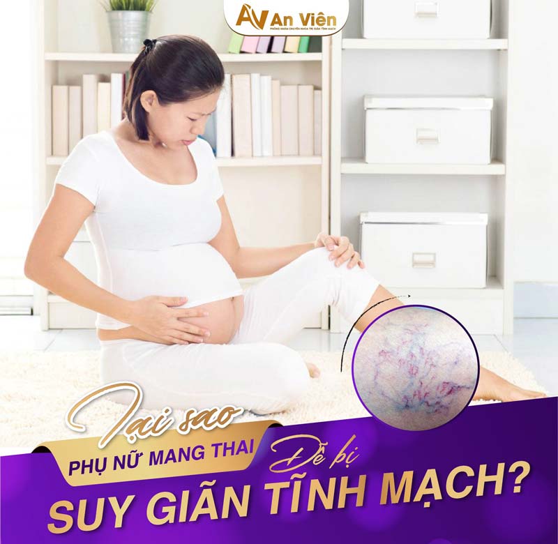 chữa suy giãn tĩnh mạch chân
