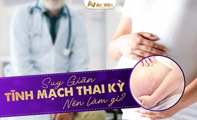 chữa suy giãn tĩnh mạch chân