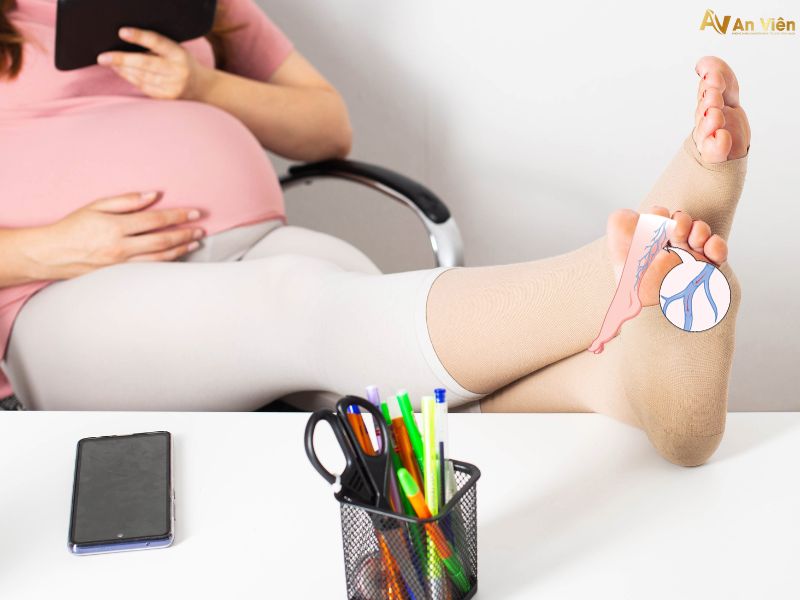 cách chữa suy giãn tĩnh mạch chân