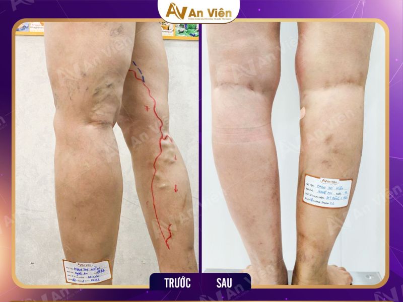An Viên điều trị giãn tĩnh mạch chi dưới bằng keo sinh học 13 điều trị giãn tĩnh mạch chi dưới