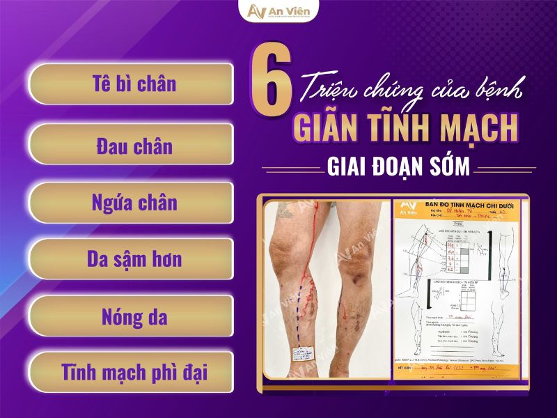 An Viên điều trị giãn tĩnh mạch chi dưới bằng keo sinh học 17 điều trị giãn tĩnh mạch chi dưới