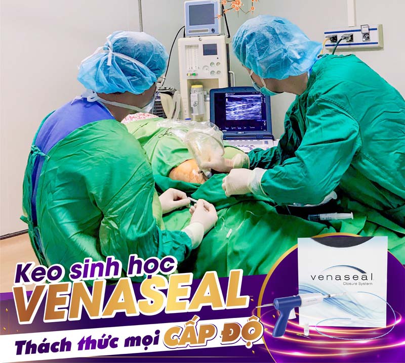 An Viên điều trị giãn tĩnh mạch chi dưới bằng keo sinh học 12 điều trị giãn tĩnh mạch chi dưới