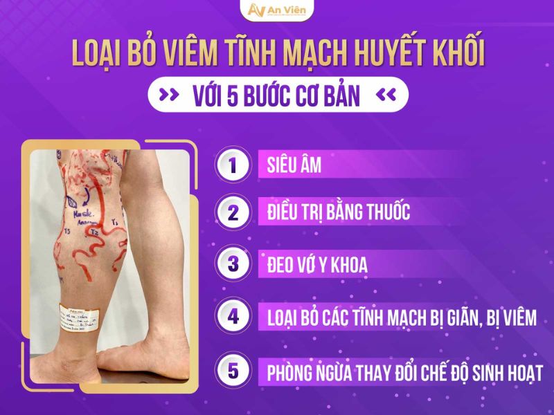 Lắng nghe bác sĩ lý giải nên hiểu viêm tĩnh mạch huyết khối như thế nào? 15 viêm tĩnh mạch huyết khối