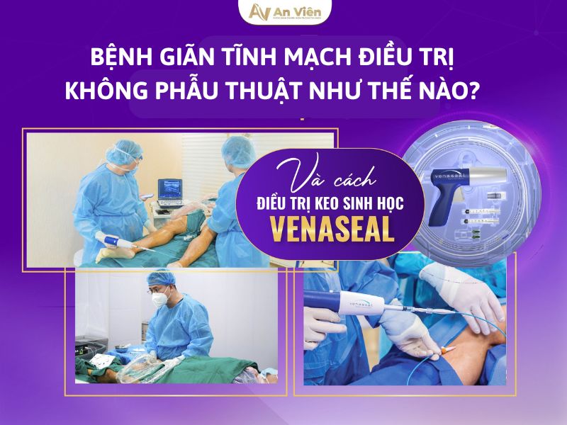 Tại An Viên: Bệnh giãn tĩnh mạch và cách điều trị hiệu quả 10 bệnh giãn tĩnh mạch và cách điều trị