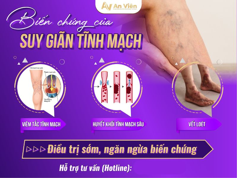 biểu hiện giãn tĩnh mạch ở chân