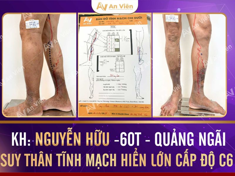 biểu hiện giãn tĩnh mạch ở chân