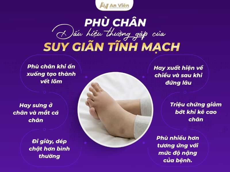 biểu hiện giãn tĩnh mạch ở chân