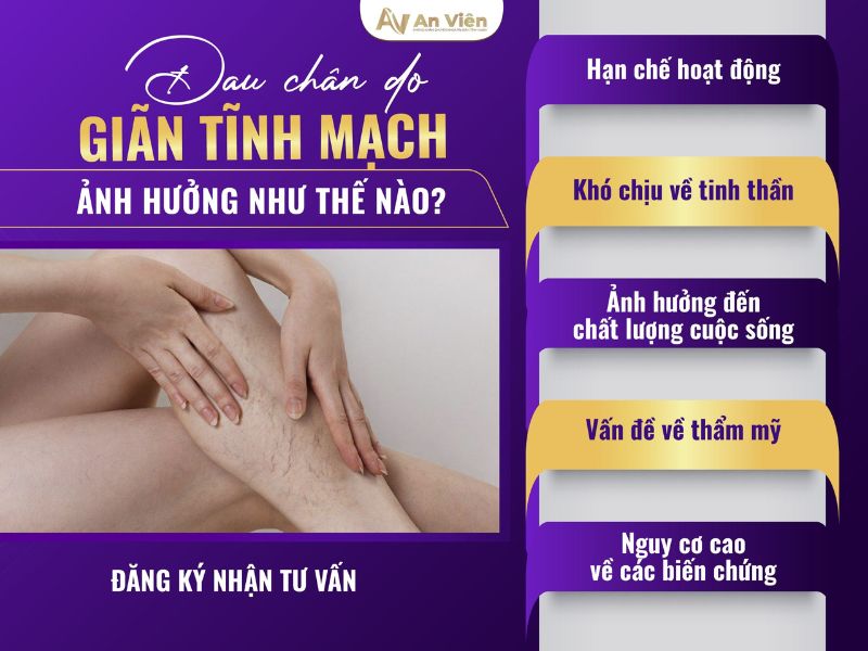 Điểm tên 9 cách chống giãn tĩnh mạch chân tại nhà đơn giản 10 cách chống giãn tĩnh mạch chân