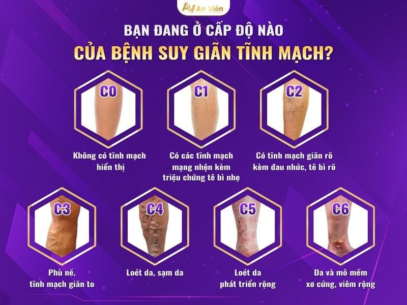 cách trị suy giãn tĩnh mạch ở chân