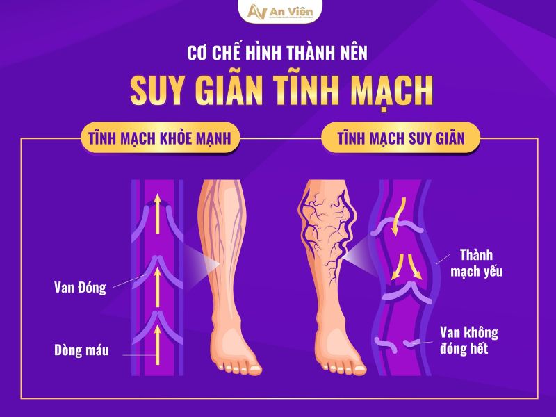 cách trị suy giãn tĩnh mạch ở chân