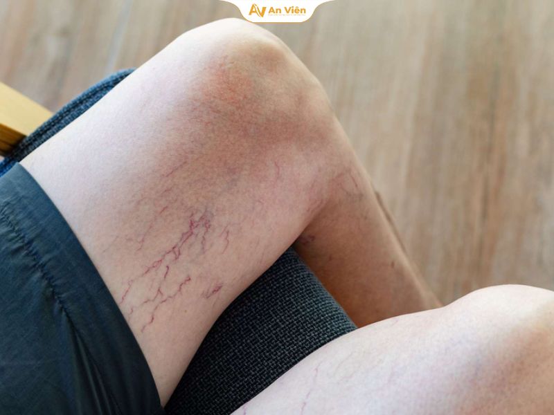 Tình trạng chân bị nổi gân đỏ