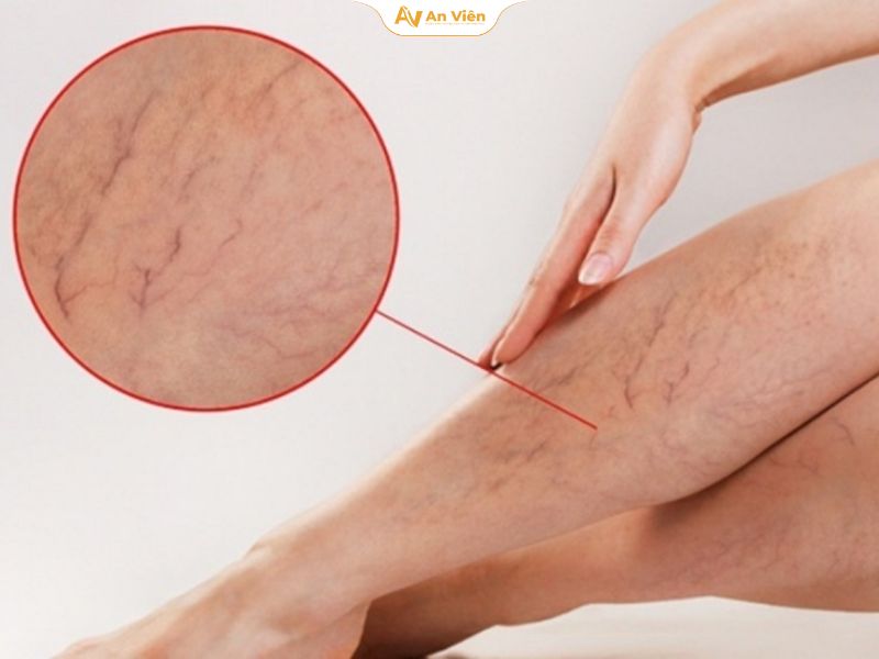 Giãn tĩnh mạch mạn tính