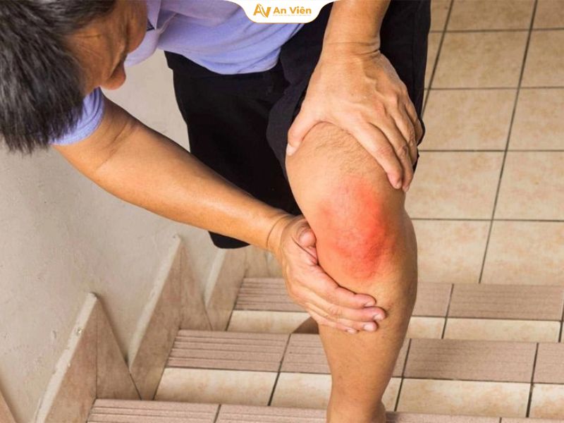 Chân nổi gân đỏ do chấn thương