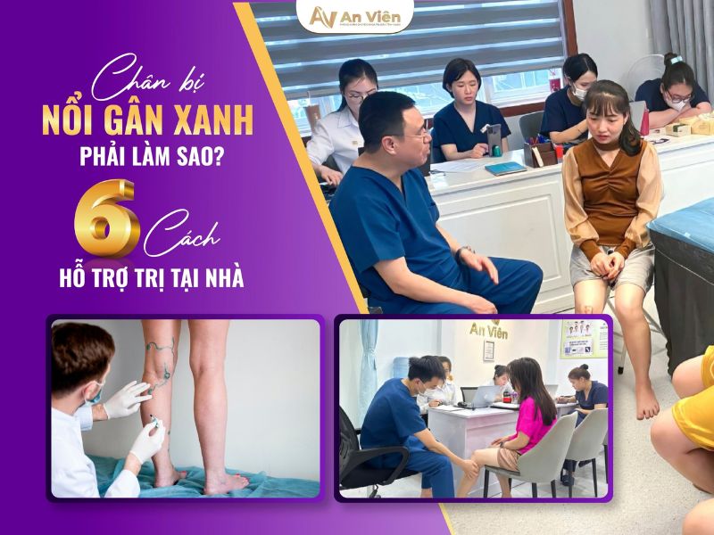 chân bị nổi gân xanh phải làm sao
