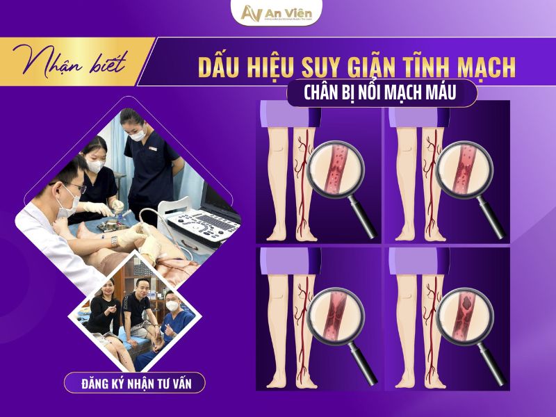 chân bị nổi mạch máu đỏ